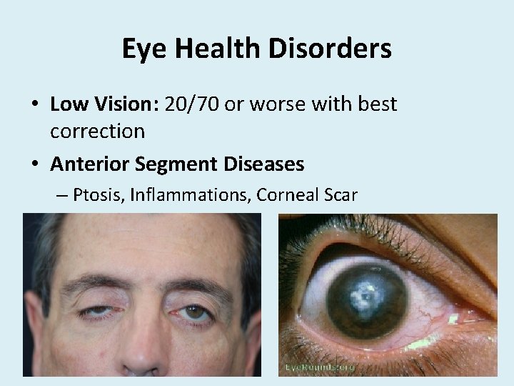 Eye Health Disorders • Low Vision: 20/70 or worse with best correction • Anterior