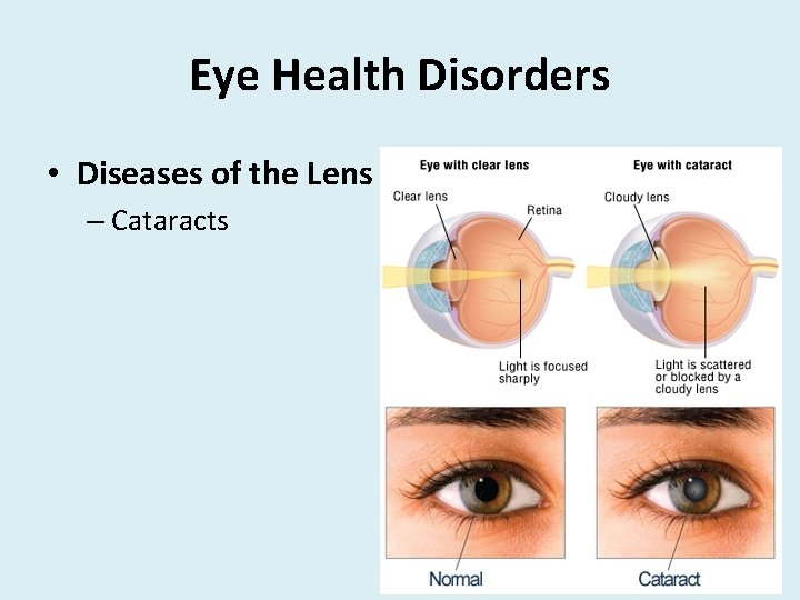 Eye Health Disorders • Diseases of the Lens – Cataracts 