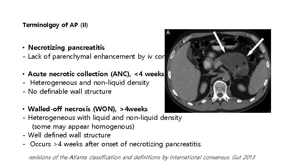 Terminolgoy of AP (II) • Necrotizing pancreatitis - Lack of parenchymal enhancement by iv