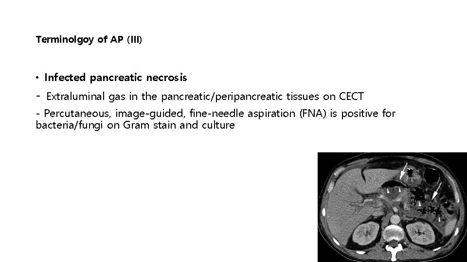 Terminolgoy of AP (III) • Infected pancreatic necrosis - Extraluminal gas in the pancreatic/peripancreatic