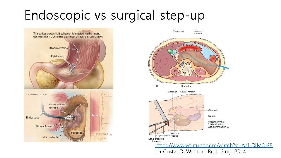 Endoscopic vs surgical step-up https: //www. youtube. com/watch? v=Agl_Dj. MOi 38 da Costa, D.