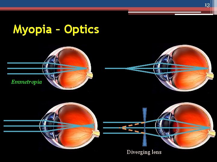 13 Myopia – Optics Emmetropia Diverging lens 