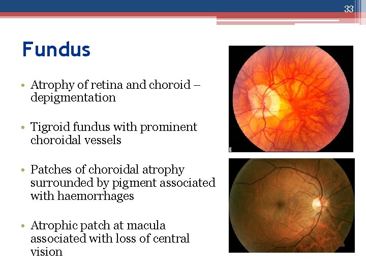 33 Fundus • Atrophy of retina and choroid – depigmentation • Tigroid fundus with