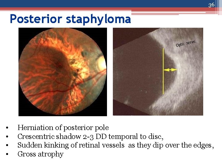 36 Posterior staphyloma • • Herniation of posterior pole Crescentric shadow 2 -3 DD