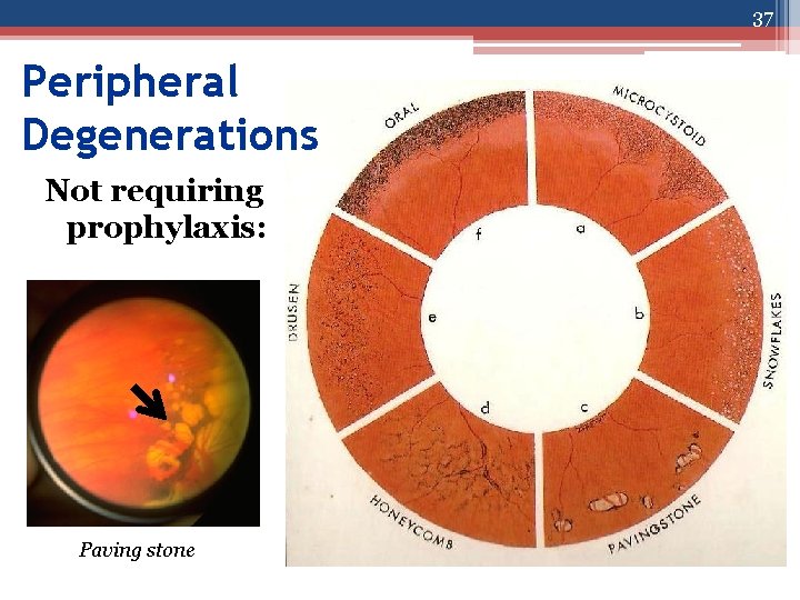 37 Peripheral Degenerations Not requiring prophylaxis: Paving stone 