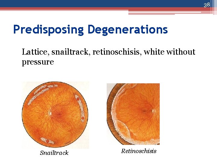 38 Predisposing Degenerations Lattice, snailtrack, retinoschisis, white without pressure Snailtrack Retinoschisis 