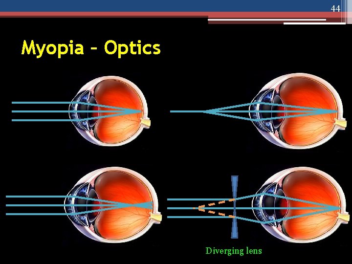 44 Myopia – Optics Diverging lens 