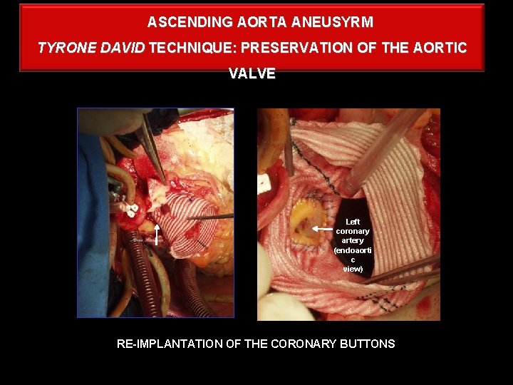 ASCENDING AORTA ANEUSYRM TYRONE DAVID TECHNIQUE: PRESERVATION OF THE AORTIC VALVE Left coronary artery