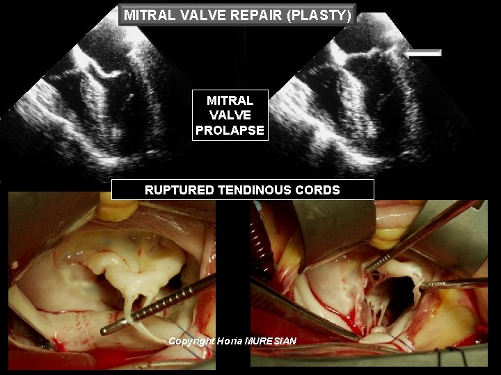 MITRAL VALVE REPAIR (PLASTY) MITRAL VALVE PROLAPSE RUPTURED TENDINOUS CORDS Copyright Horia MURESIAN 