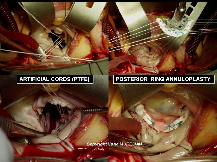 ARTIFICIAL CORDS (PTFE) POSTERIOR RING ANNULOPLASTY Copyright Horia MURESIAN 