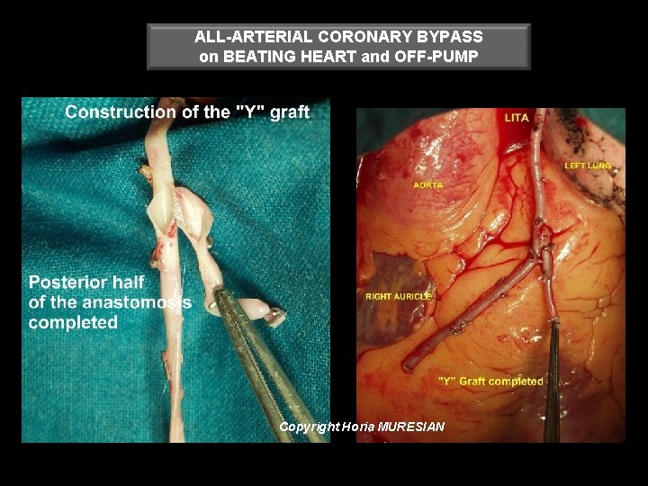 ALL-ARTERIAL CORONARY BYPASS on BEATING HEART and OFF-PUMP Copyright Horia MURESIAN 