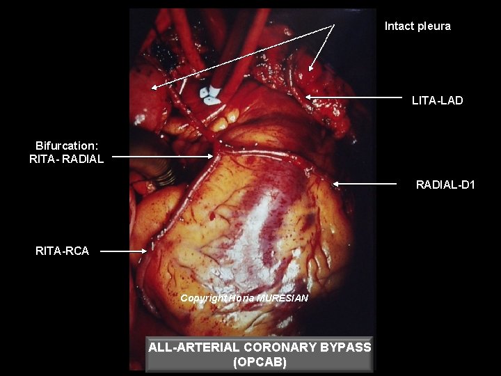 Intact pleura LITA-LAD Bifurcation: RITA- RADIAL-D 1 RITA-RCA Copyright Horia MURESIAN ALL-ARTERIAL CORONARY BYPASS