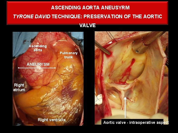 ASCENDING AORTA ANEUSYRM TYRONE DAVID TECHNIQUE: PRESERVATION OF THE AORTIC VALVE Ascending aorta Pulmonary