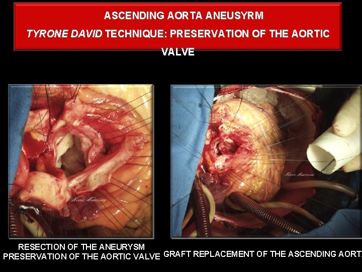 ASCENDING AORTA ANEUSYRM TYRONE DAVID TECHNIQUE: PRESERVATION OF THE AORTIC VALVE RESECTION OF THE