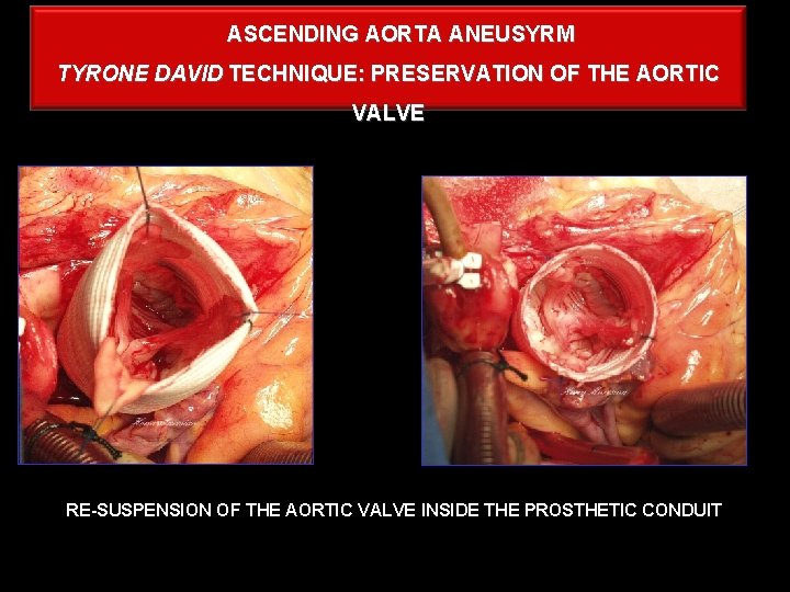 ASCENDING AORTA ANEUSYRM TYRONE DAVID TECHNIQUE: PRESERVATION OF THE AORTIC VALVE RE-SUSPENSION OF THE