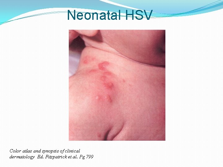 Neonatal HSV Color atlas and synopsis of clinical dermatology Ed. Fitzpatrick et al. Pg