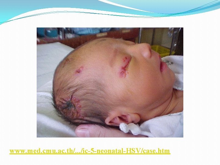 www. med. cmu. ac. th/. . . /ic-5 -neonatal-HSV/case. htm 