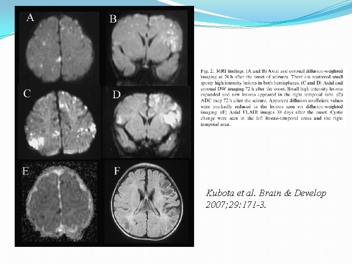 Kubota et al. Brain & Develop 2007; 29: 171 -3. 