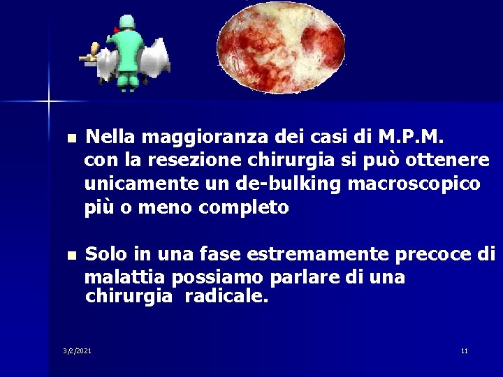 n Nella maggioranza dei casi di M. P. M. con la resezione chirurgia si