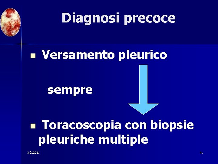 Diagnosi precoce Versamento pleurico n sempre n Toracoscopia con biopsie pleuriche multiple 3/2/2021 41