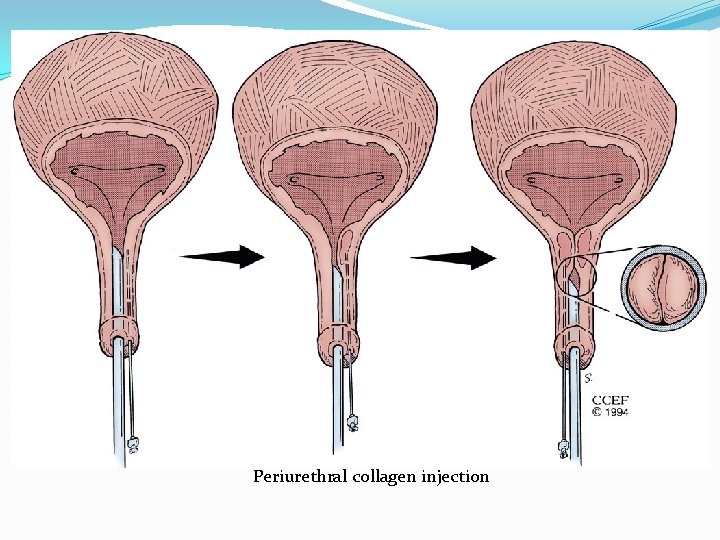 Periurethral collagen injection 