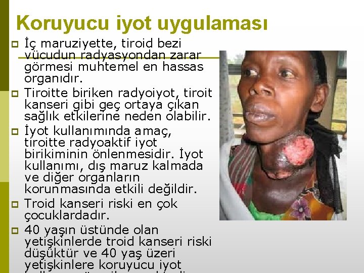 Koruyucu iyot uygulaması p p p İç maruziyette, tiroid bezi vücudun radyasyondan zarar görmesi