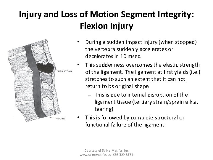 Injury and Loss of Motion Segment Integrity: Flexion Injury • During a sudden impact