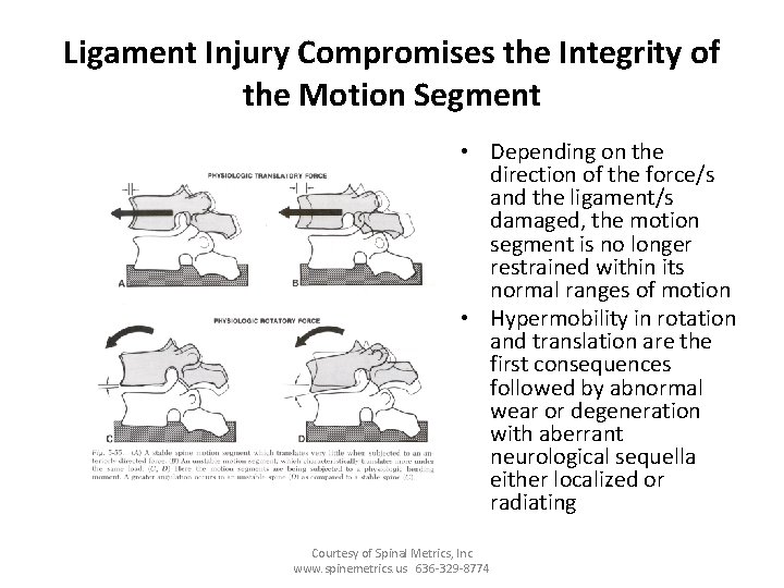 Ligament Injury Compromises the Integrity of the Motion Segment • Depending on the direction