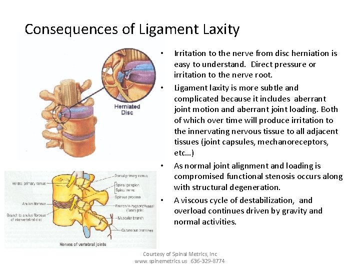 Consequences of Ligament Laxity • • Irritation to the nerve from disc herniation is