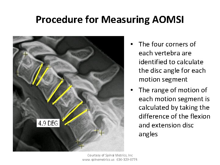 Procedure for Measuring AOMSI • The four corners of each vertebra are identified to