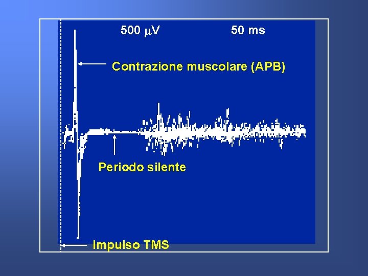 500 V 50 ms Contrazione muscolare (APB) Periodo silente Impulso TMS 