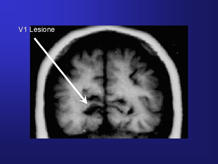 V 1 Lesione 