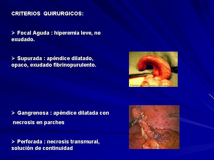 CRITERIOS QUIRURGICOS: Ø Focal Aguda : hiperemia leve, no exudado. Ø Supurada : apéndice