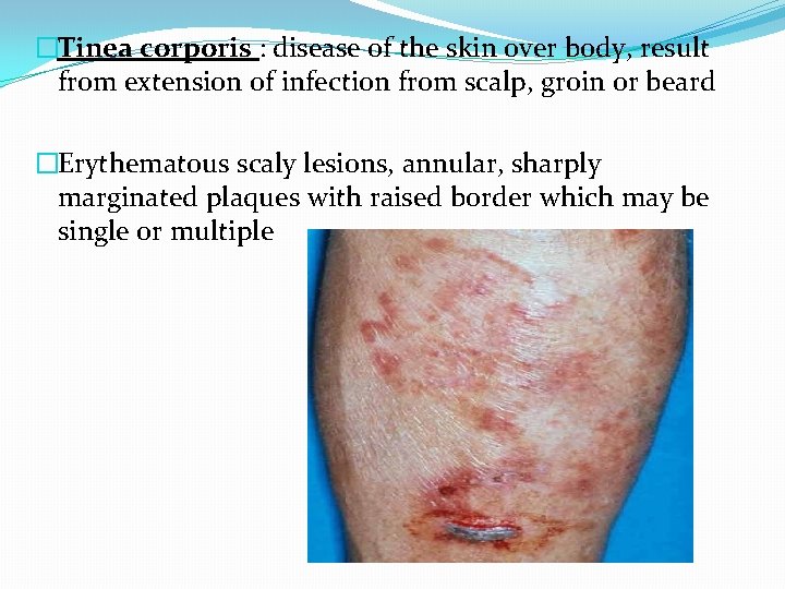 �Tinea corporis : disease of the skin over body, result from extension of infection