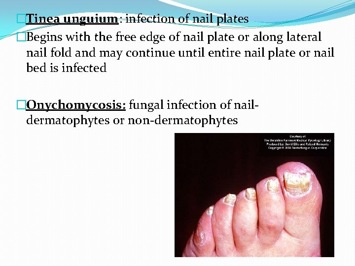 �Tinea unguium: infection of nail plates �Begins with the free edge of nail plate