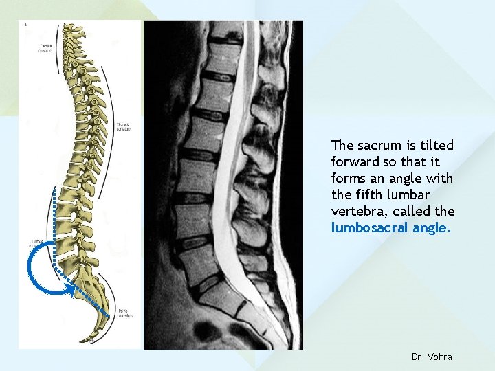 The sacrum is tilted forward so that it forms an angle with the fifth