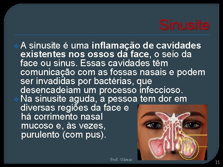 Sinusite v A sinusite é uma inflamação de cavidades existentes nos ossos da face,