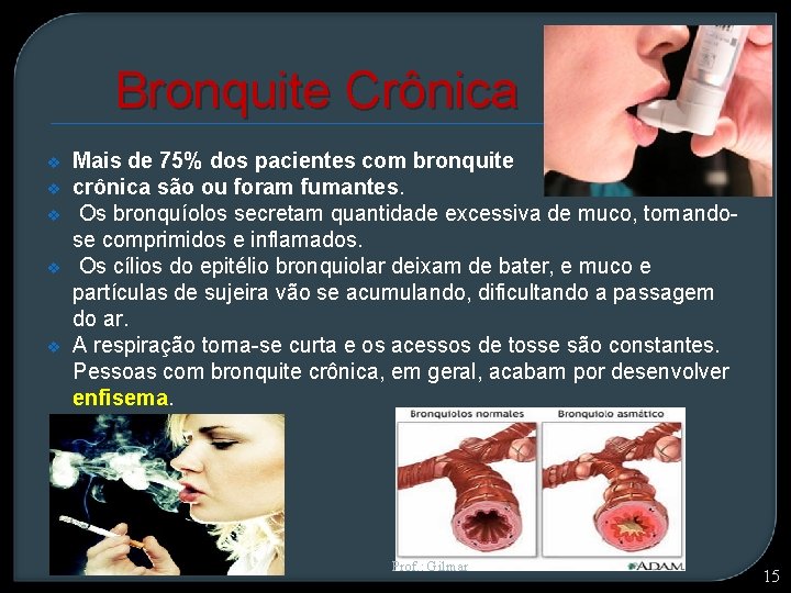 Bronquite Crônica v v v Mais de 75% dos pacientes com bronquite crônica são