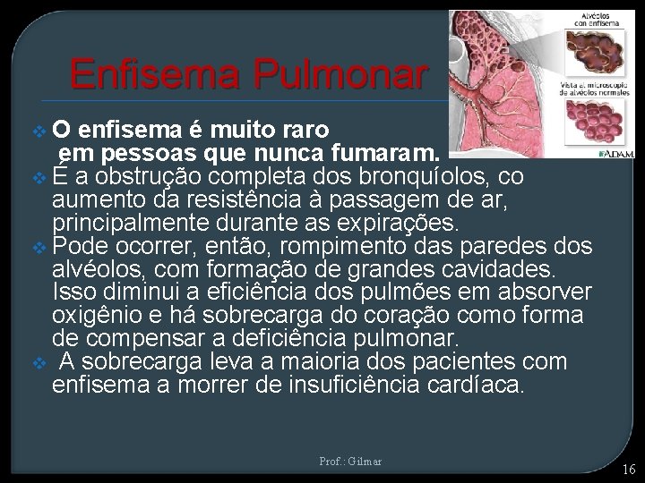 Enfisema Pulmonar v. O enfisema é muito raro em pessoas que nunca fumaram. v