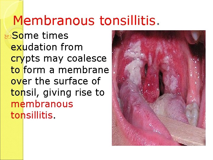 Membranous tonsillitis. Some times exudation from crypts may coalesce to form a membrane over