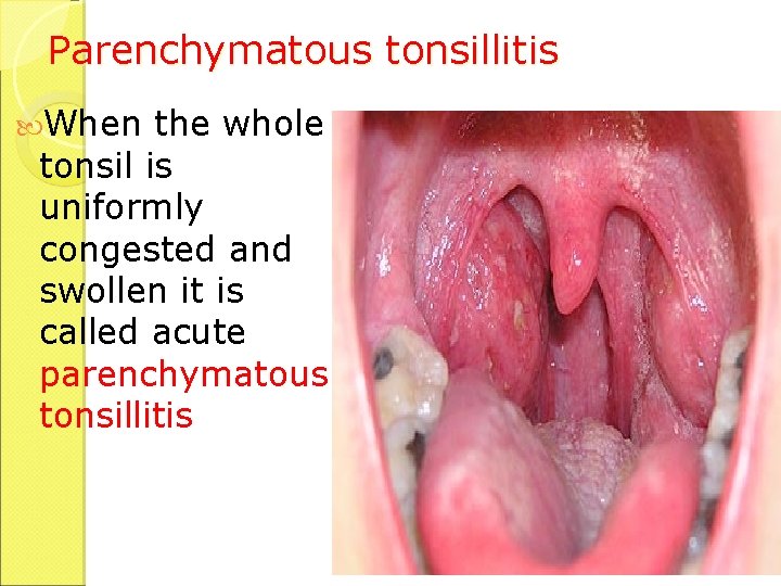 Parenchymatous tonsillitis When the whole tonsil is uniformly congested and swollen it is called