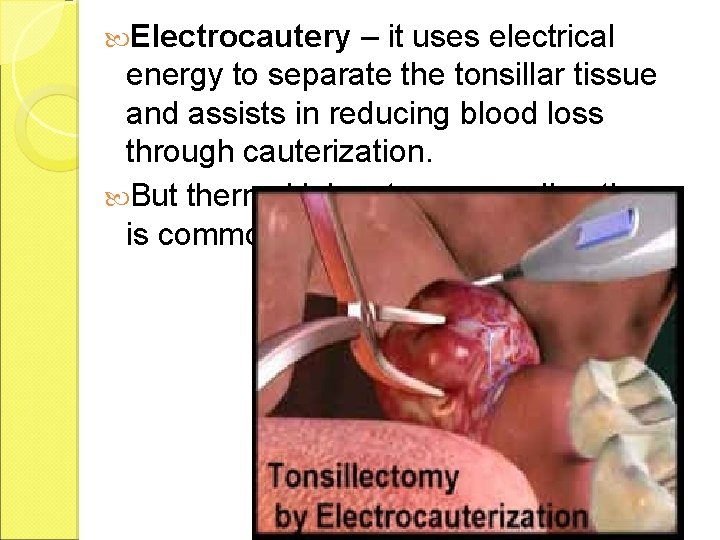  Electrocautery – it uses electrical energy to separate the tonsillar tissue and assists