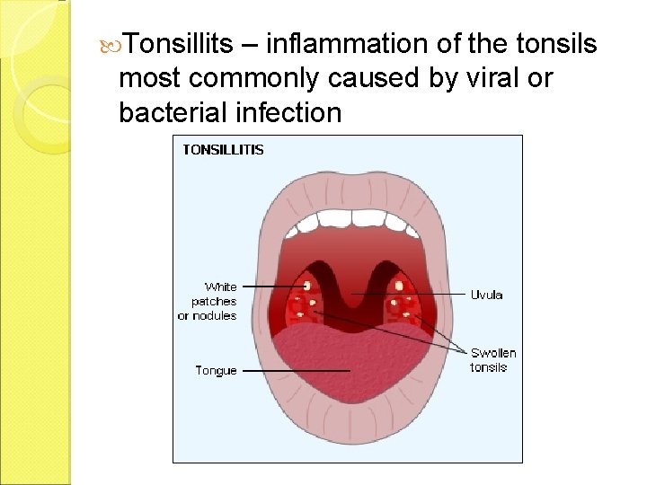  Tonsillits – inflammation of the tonsils most commonly caused by viral or bacterial