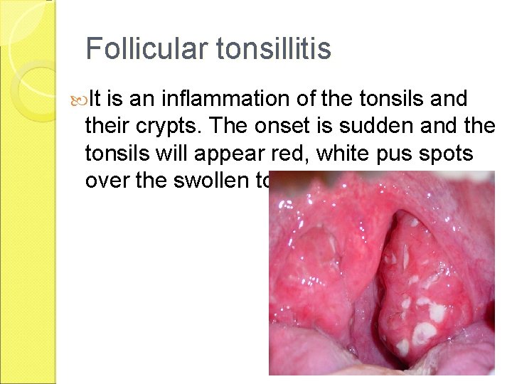 Follicular tonsillitis It is an inflammation of the tonsils and their crypts. The onset