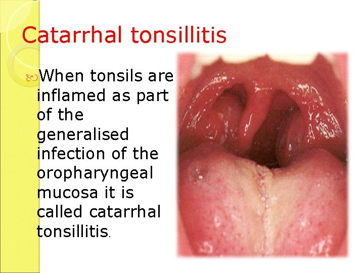 Catarrhal tonsillitis When tonsils are inflamed as part of the generalised infection of the