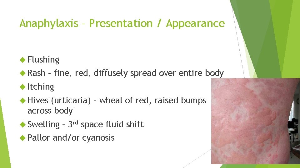 Anaphylaxis – Presentation / Appearance Flushing Rash – fine, red, diffusely spread over entire