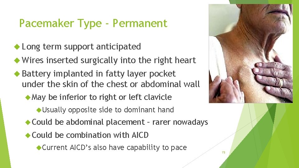 Pacemaker Type - Permanent Long term support anticipated Wires inserted surgically into the right