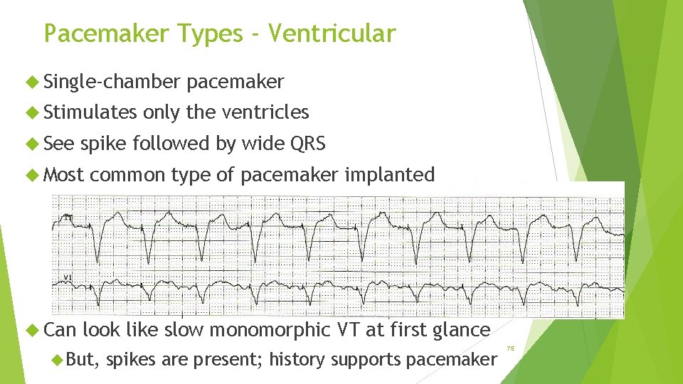 Pacemaker Types - Ventricular Single-chamber Stimulates See only the ventricles spike followed by wide