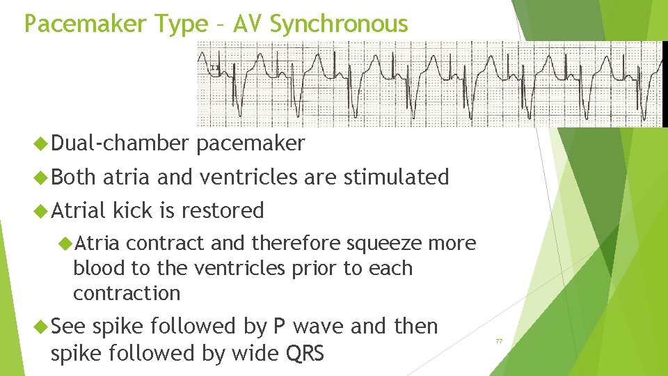 Pacemaker Type – AV Synchronous Dual-chamber Both pacemaker atria and ventricles are stimulated Atrial