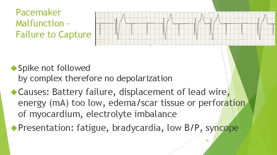 Pacemaker Malfunction – Failure to Capture Spike not followed by complex therefore no depolarization